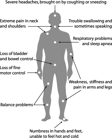 Chiari Symptoms Image